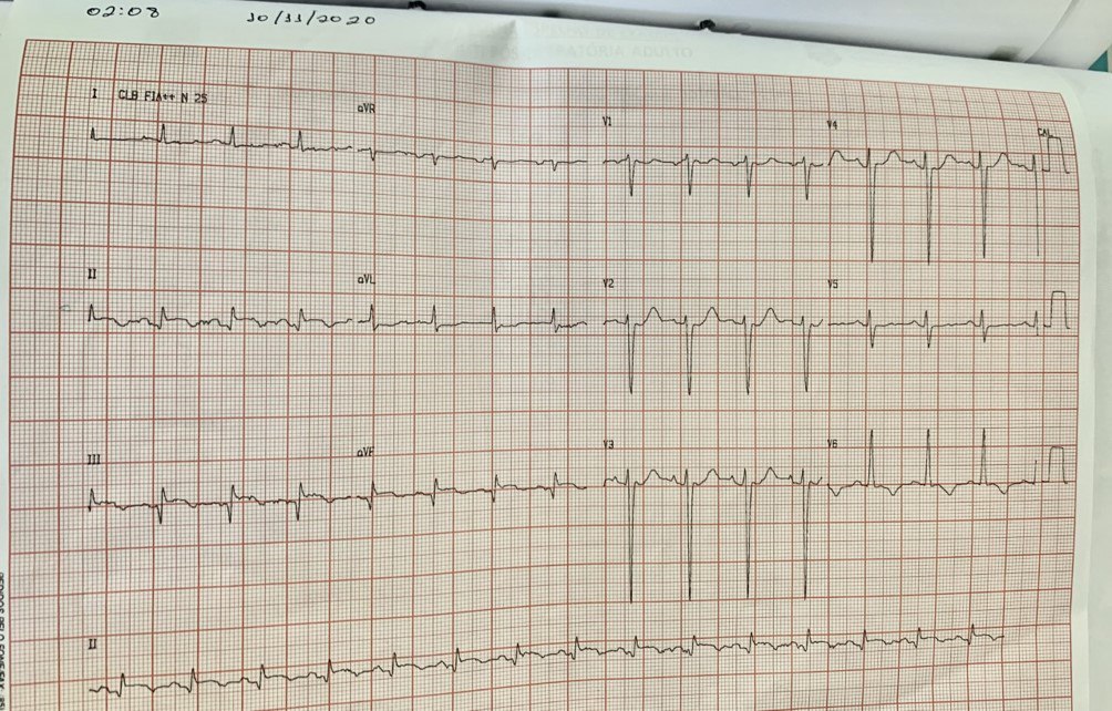 Paciente de 59 años con antecedente de IAM de cara inferior dos meses previos a su ingreso actual con trombolisis e implante de stent a la CD y severo cuadro respiratorio por COVID 19
