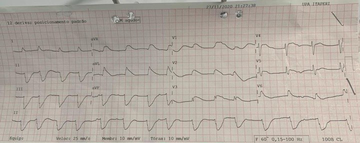 Paciente masculino de 26 años sin antecedentes que presenta episodio sincopal en un autobus recibiendo RCP que ingresa al Hospital con FV de la cuál revierte con CVE constatándose a posteriori presencia de patrón de Brugada tipo I