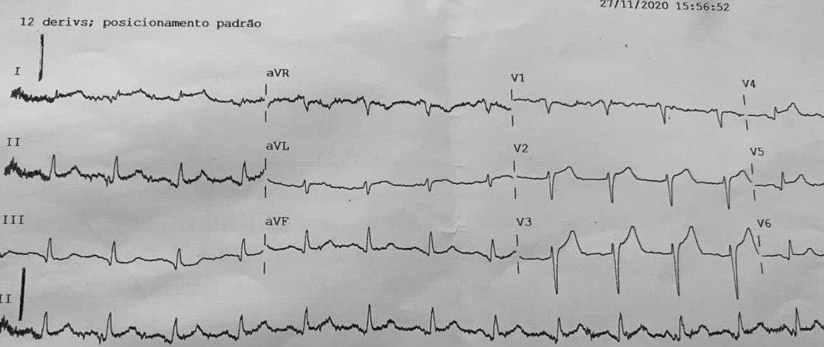 Hombre de 77 años, HTA y TBQ que presenta episodio de ángor prolongado que ingresa luego de 12 horas de dolor, que cursa con CCG normal, baja FEy y presencia de aneurisma apical con trombo por ¿espasmo prolongado?