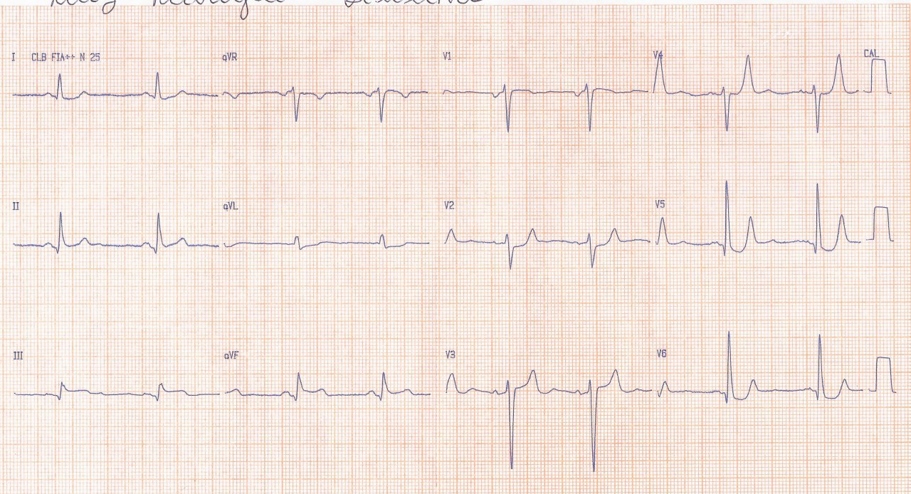 Paciente cursando SCA por compromiso de la arteria obtuso marginal de la Cx y suboclusión de la DA