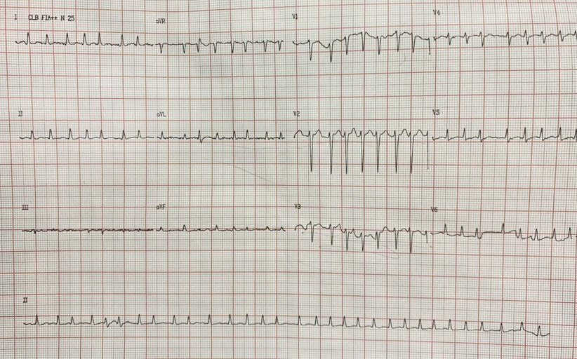 Mujer de 61 años con disnea de esfuerzo, ortopnea y DPN que presenta FAARV en contexto de hipotiroidismo con valores de TSH de 6,67 y T4 libre < 0,005