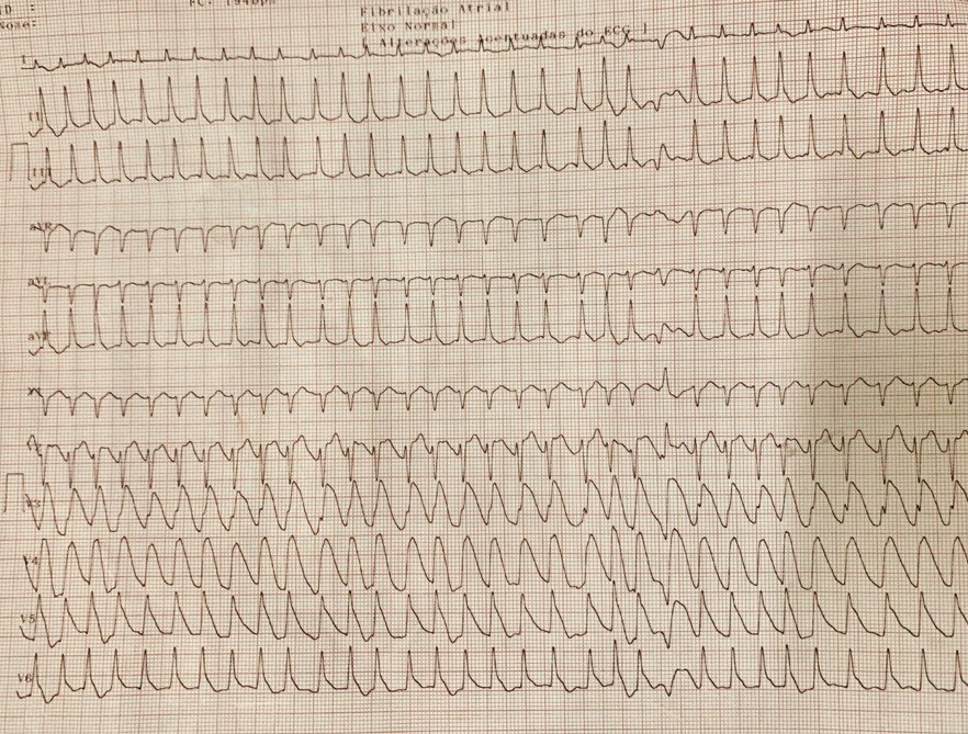 Mujer de 80 años con pérdida temporal de consciencia que presenta FAARV ritmo que rota a ritmo unional con ondas lambda con CCG normal por presencia de síndrome de takotsubo