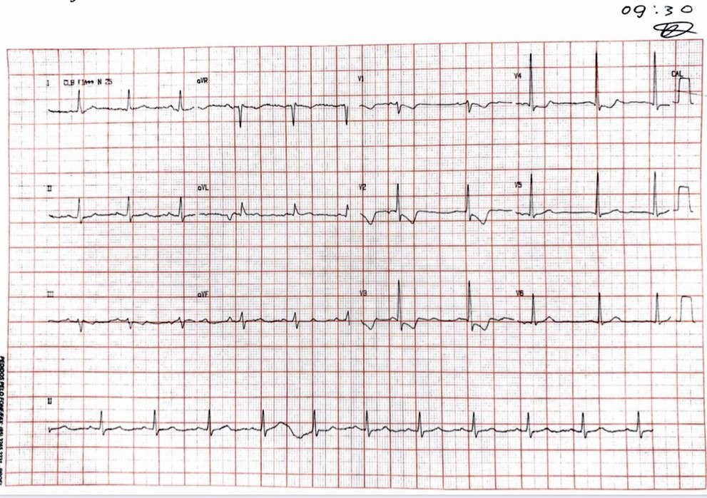 Paciente de 67 años con factores de riesgo y antecedentes de revascularización previa que presenta episodio de ángor que presenta CD calcificada y tortuosa con lesión de 80% ostial y 80% distal y lesión del 30% en tercio proximal de DA