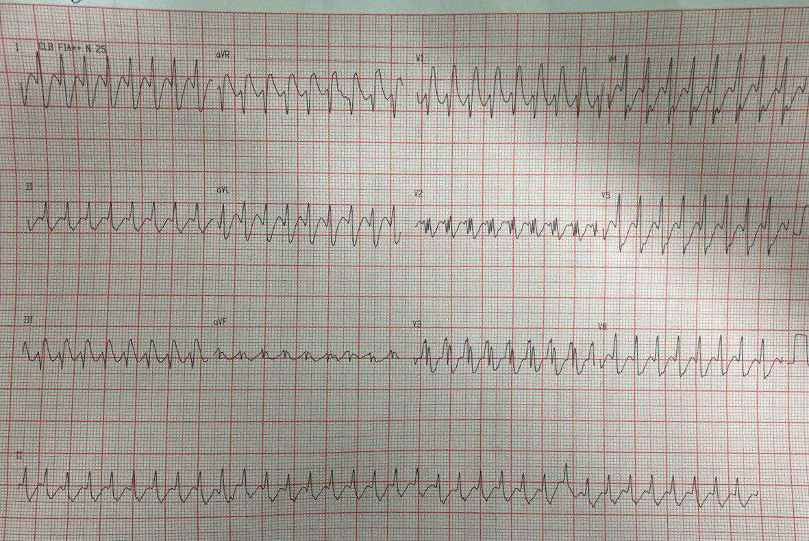 Paciente de 52 años, hipertenso y obeso que presenta palpitaciones de reciente comienzo que presenta una taquicardia de QRS ancho con morfología típica de BRD, sin desviación del eje, de inicio rápido que responde a la adenosina: ¿TRAVO o TRIN?