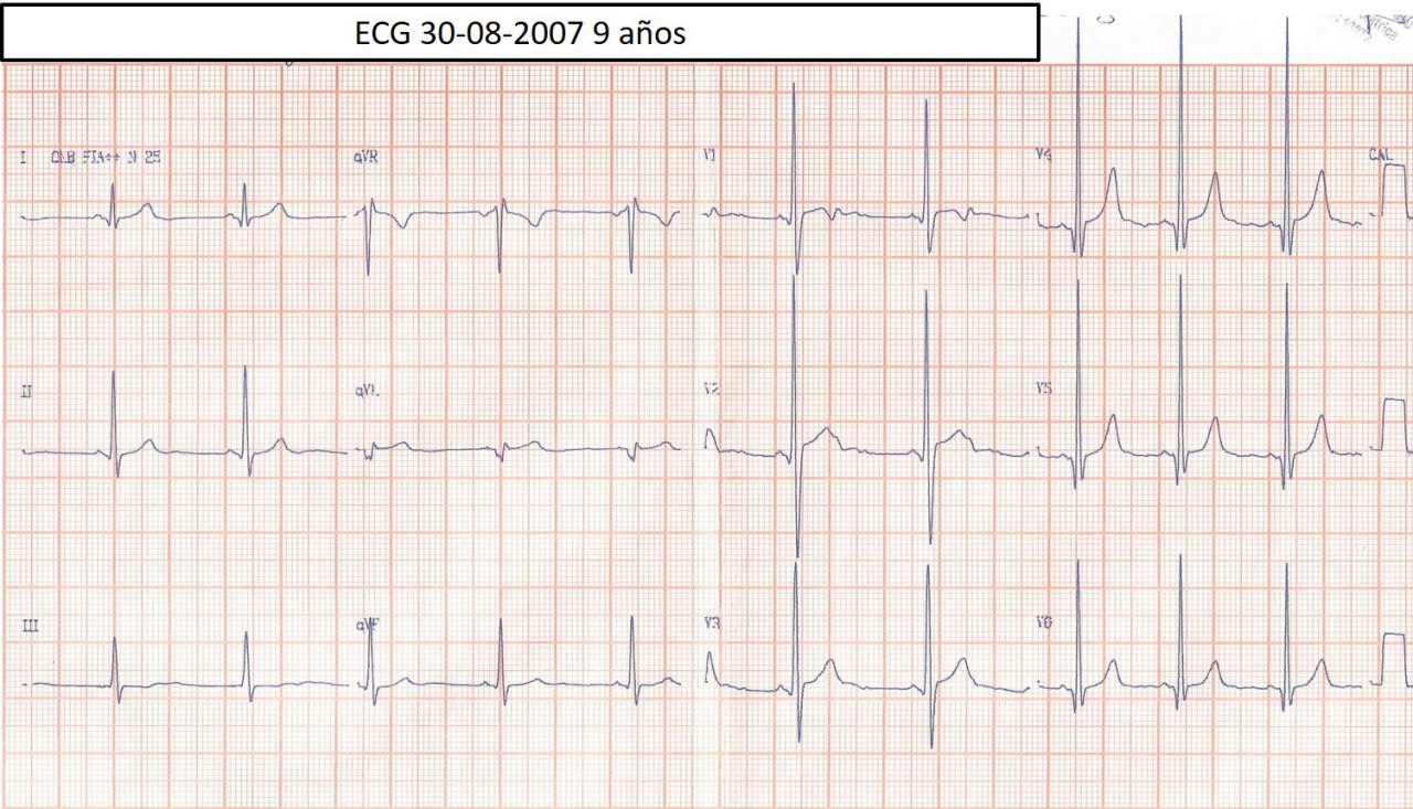 Varón de 21 años con historia de debilidad muscular progresiva, que comienza a los 3 años con caídas frecuentes que presenta importante fibrosis  en la región lateral  del VI cerca del músculo papilar posterior en contexto de distrofia muscular progresiva de Aran – Duchenne