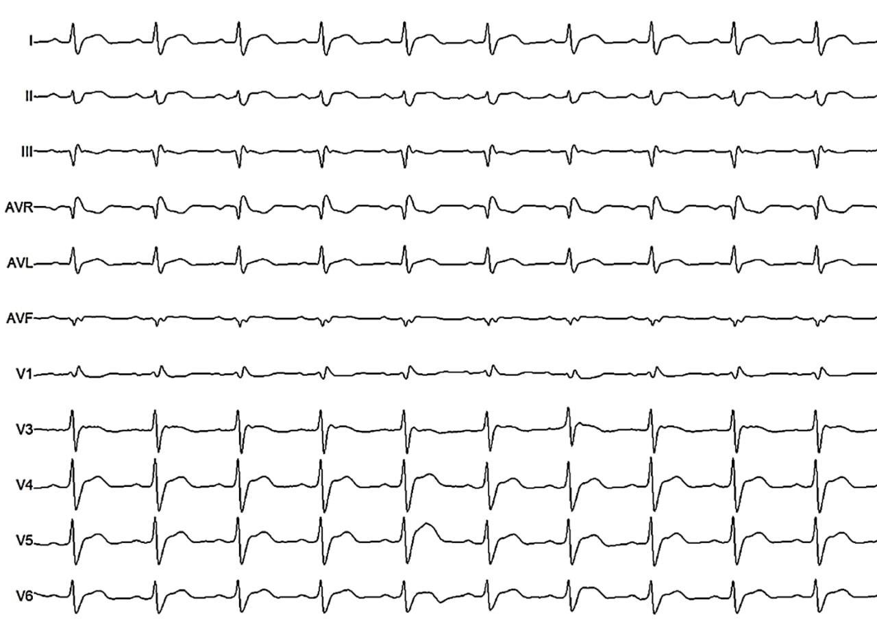 Paciente de 63 años, hipertenso y dislipémico que presenta episodio sincopal que responde al MSC con una pausa prolongada por hipersensibilidad del seno carotídeo