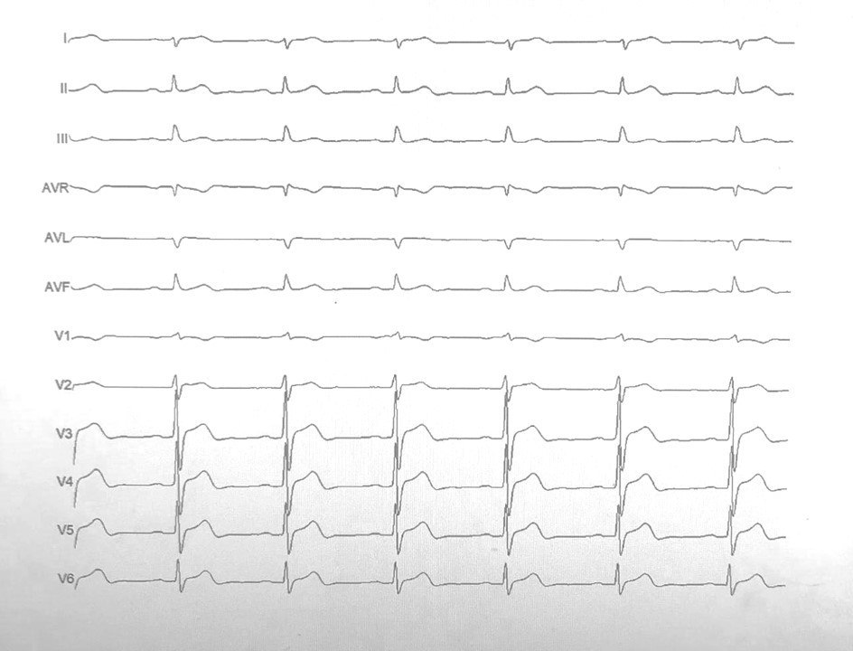 Paciente de 44 años con distrofia tipo I (Steinert), asintomático con familiares que tienen un marcapasos, quien en el estudio EEF presentó Intervalo HV de 74ms sin inducción de arritmias