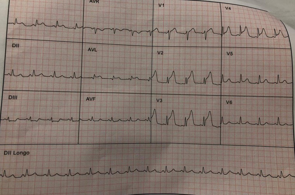 Hombre 55 años, usuario de cocaína que presenta episodio de ángor por presencia de trombos en la DA