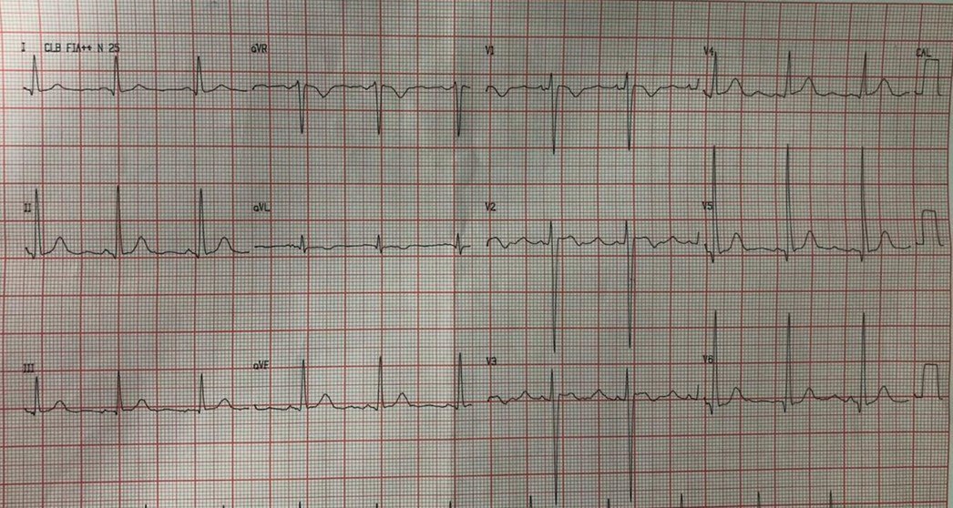 Mujer 21 años con antecedentes de fatiga de esfuerzo y disnea, que presenta soplo cardíaco contínuo por la presencia de ductus arterioso