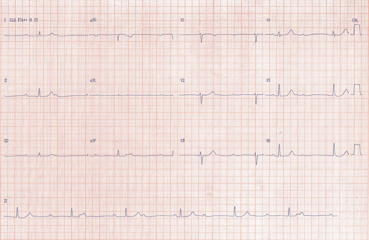 Mujer 26 años que refiere disnea a grandes esfuerzos y precordalgia punzante que refiere ser portadora de bradicardia congénita que corresponde a un BAVC congénito