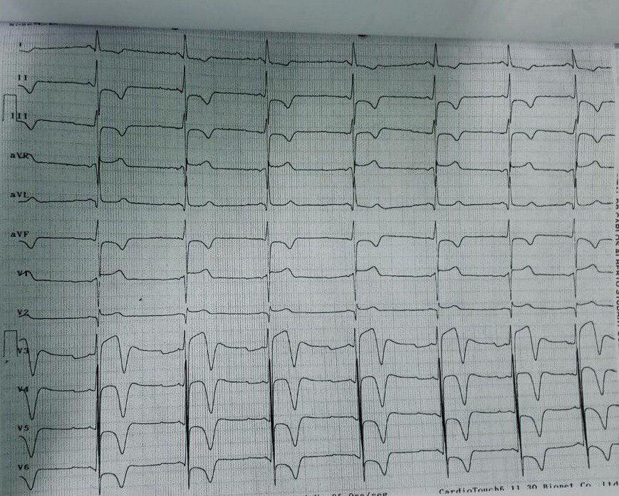 Atleta de raza negra de 41 años, ex consumidor de cocaína que presenta dolor epigástrico, troponina negativa y CCG normal y ECG sugestivo de corazón de atleta, con sospecha de miocardiopatía hipertrófica a descartar con ecocardiograma y RNM (aún no realizadas)