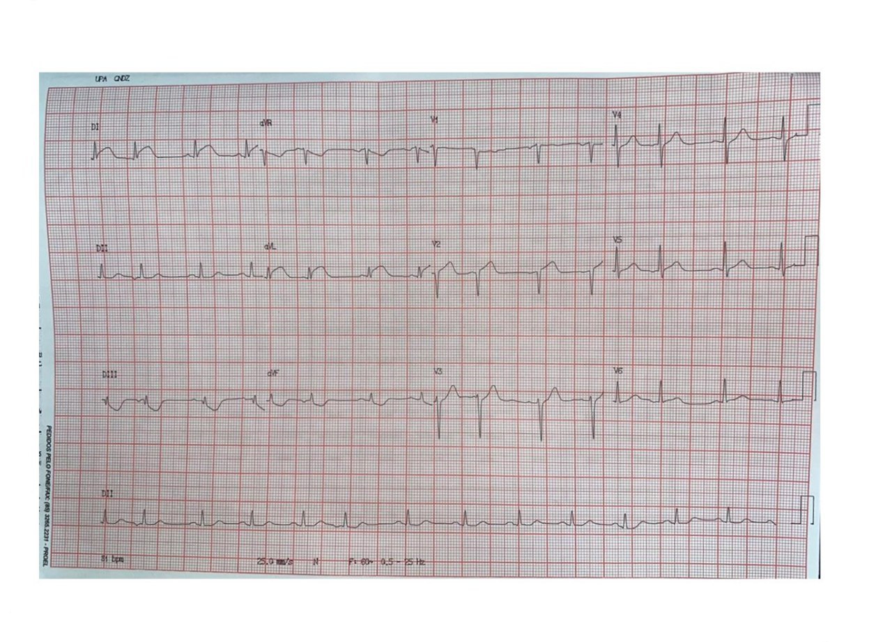 Paciente de 57 años,  HTA con episodio de ángor por oclusión de la 1º diagonal