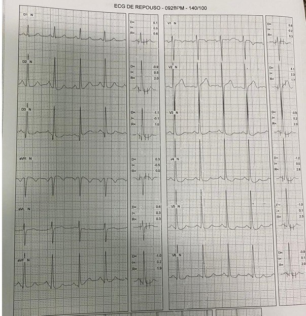 Hombre de 49 años que presenta dolor anginoso al pedalear por una calle con pendiente que realiza PEG + y que presenta lesión de TCI