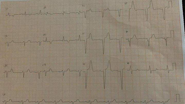 Hombre de 61 portador de IRC dialítica que pierde una sesión de hemodiálisis y comienza con disnea, con severa hiper K que mejoran al realizar la diálisis