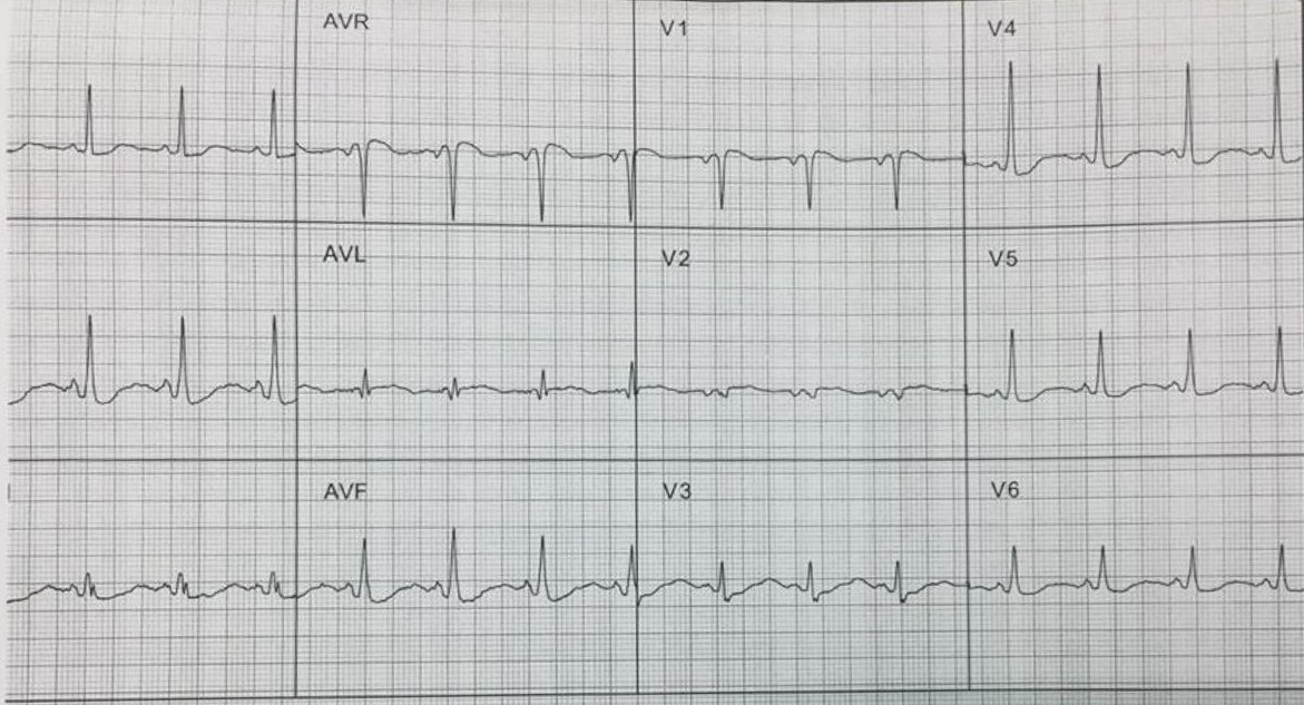 Mujer hipertensa tratada con diuréticos, con vómitos desde hace una semana, falta de apetito y debilidad, asociados con malestar epigástrico que presenta severa hipopotasemia