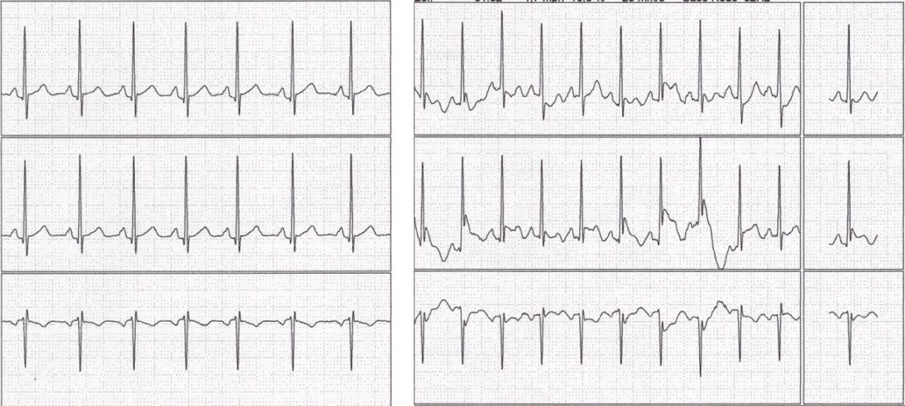 Hombre de 56 años con ECG basal normal y antecedentes  de precordialgia realiza una PEG concomitante con dolor torácico retroesternal presentando aumento de la onda J causado por isquemia durante episodio de espasmo coronario