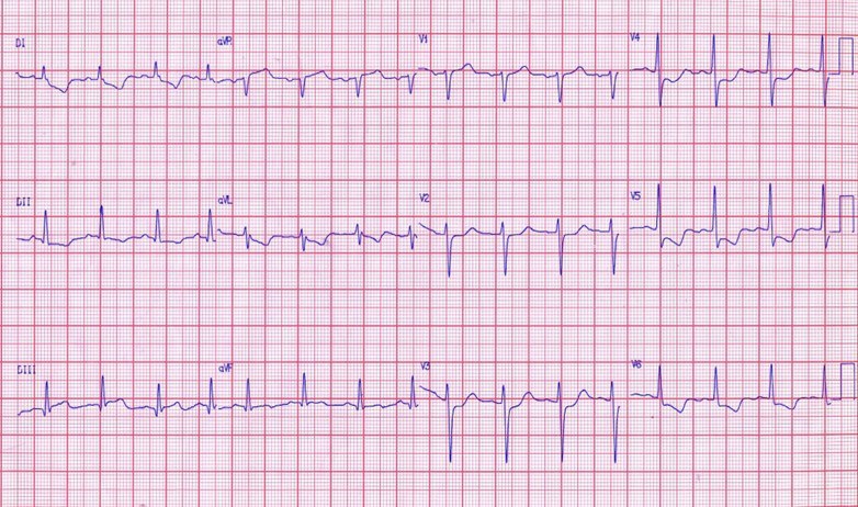 Paciente cursando un SCA siendo la CD la arteria culpable y por ende la que debe angioplastiarse primero