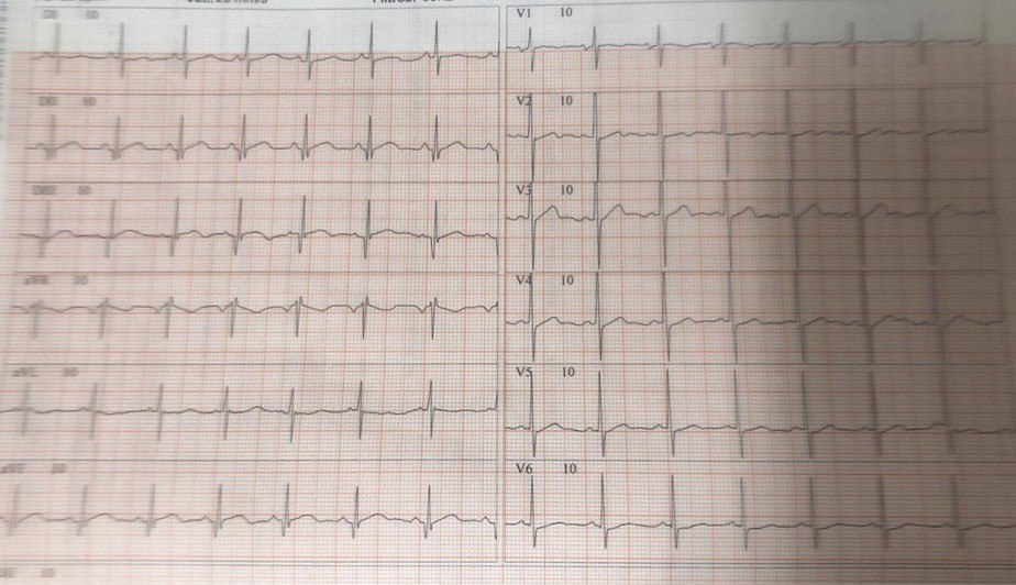 Mujer de 26 años, asintomática cursando su primer embarazo, con antecedente de padre fallecido súbitamente que presenta una MCH cuyo septo mide 34 mm