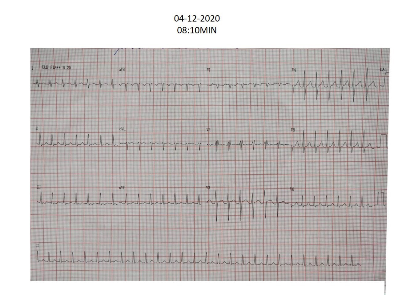 Paciente de 26 años con palpitaciones con antecedente de «ablación» dos años antes que presenta taquicardia de complejos delgados que no responde al MSC y que corresponde a un AA
