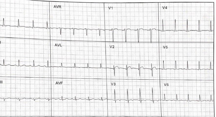 Hombre con múltiples factores de riesgo que presenta episodio de ángor cuyo primer ECG muestra un patrón de Wellens que 10 minutos más tarde rota a patrón de Winter e IAM por suboclusión de la DA