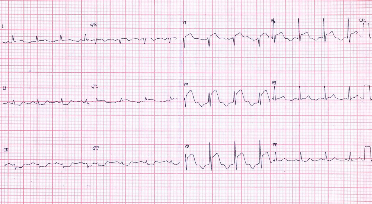 Paciente cursando SCA en cuyo ECG se observa onda U invertida de V2 a V5 que suele reflejar compromiso de la DA que efectivamente fue angioplastiada, con desaparición del fenómeno