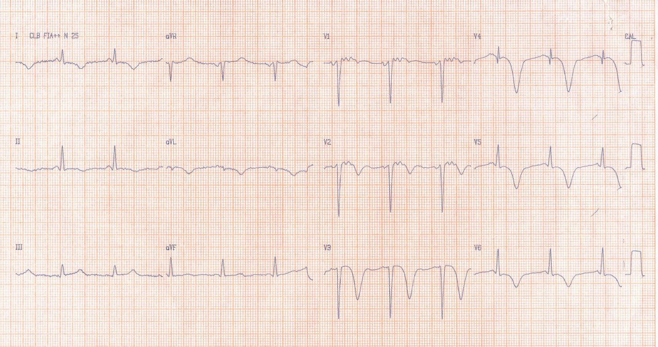 Mujer de 77 años con HTA y dislipemia que presenta episodio de ángor prolongado cuyo ECG muestra ondas T negativas gigantes y CCG normal por síndrome de Takotsubo
