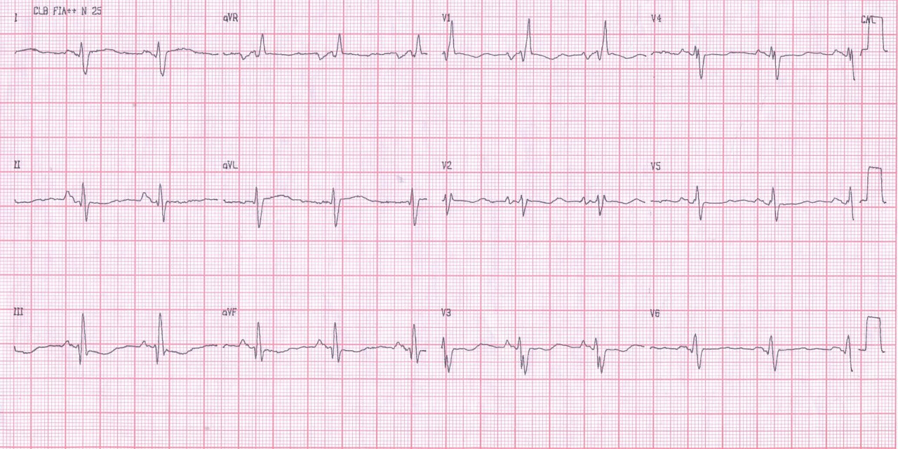 Mujer de 38 años con disnea de esfuerzo severa que presenta miocardiopatía hipertrófica obstructiva con gradiente lábil del tracto de salida del VI, insuficiencia mitral leve e hipertensión pulmonar grave