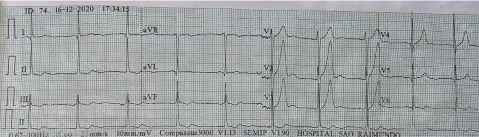 Hombre de 40 años con ángor acompañado de náuseas a quién se realizan ECGs seriados, cuyo ECG Nº1 presenta isquemia grado 1 que evoluciona a IAM constatándose tardíamente oclusión de la DA