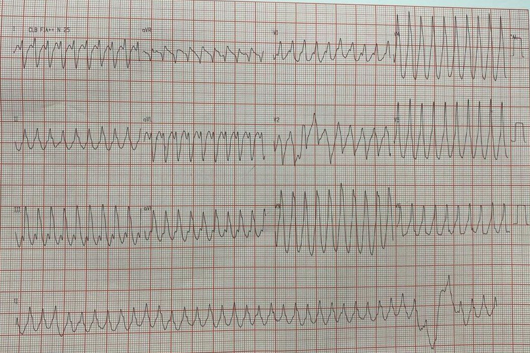 Hombre de 50 años con antecedentes sincopales, tratado con amiodarona que desarrolla TVM, que presenta acinesia basal inferior e ínfero-lateral con fQRS, con fibrosis muy extensa y alto riesgo de muerte súbita en quién se programa ablación + CDI