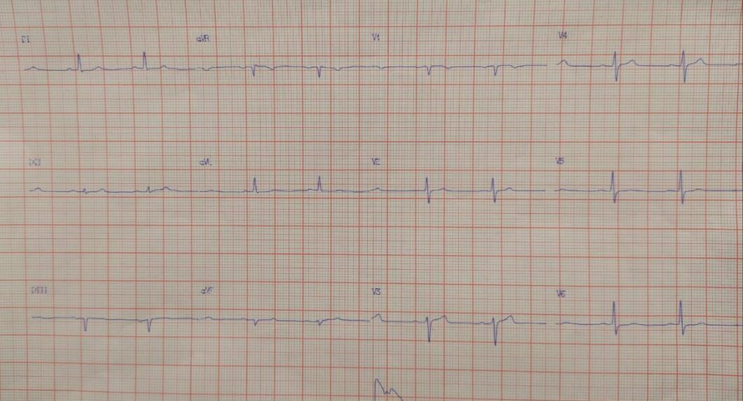 Hombre de 49 años con factores de riesgo que presenta ángor de esfuerzo de reciente comienzo que presenta lesiones graves en TCI – bifurcación / DA / CX y CD que repite episodio de ángor por oclusión de la DA, cancelándose la CRM planificada