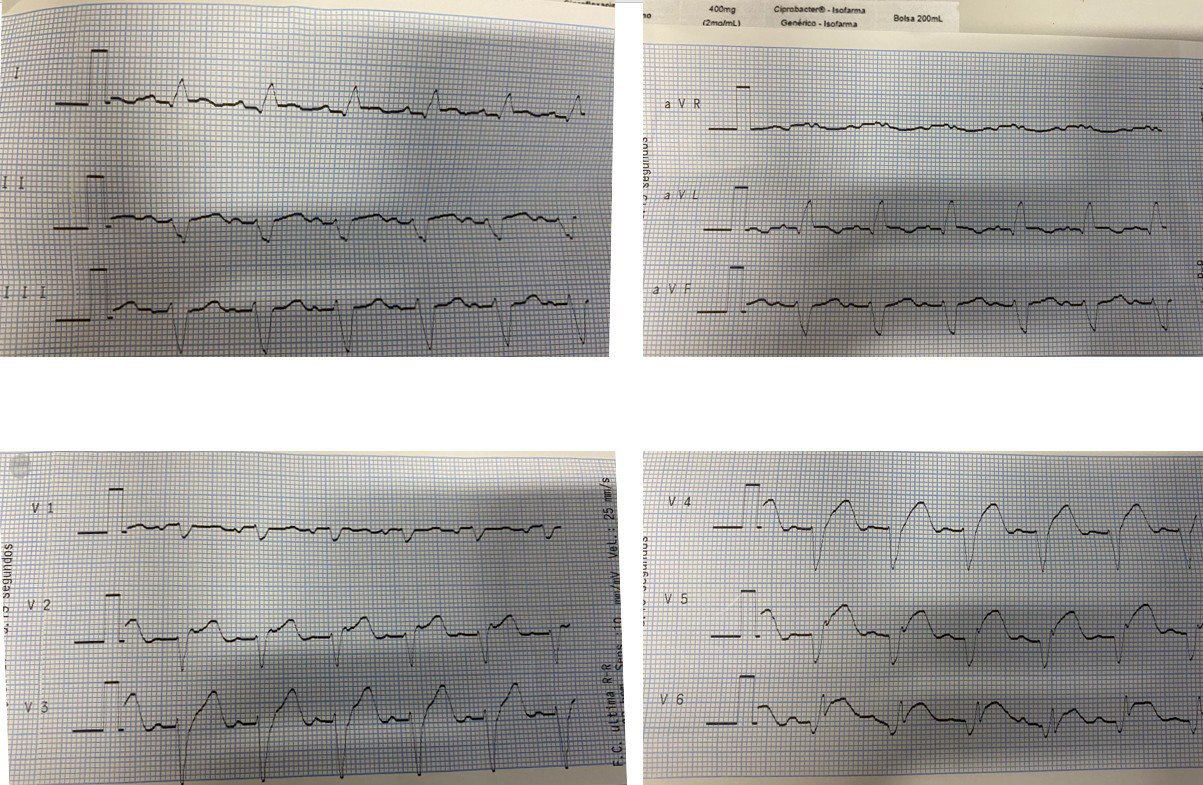 Hombre de 78 años sin comorbilidades previas que presenta episodio de ángor acompañado de síntomas y signos vagales seguido de ruptura auricular y evolución al óbito