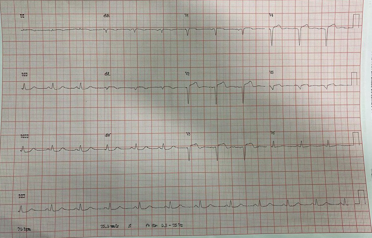 Paciente masculino de 33 años con dolor toráccico prolongado en contexto de COVID 19 que fue tratado con AAS y clopidogrel, cuya angiografía coronaria reveló trombo proximal y una estenosis del 100% en la DA a nivel de la S1 a quién se practica angioplastia quedando  con  flujo TIMI 3, pero posteriormente se constastó que S1 estaba ocluída