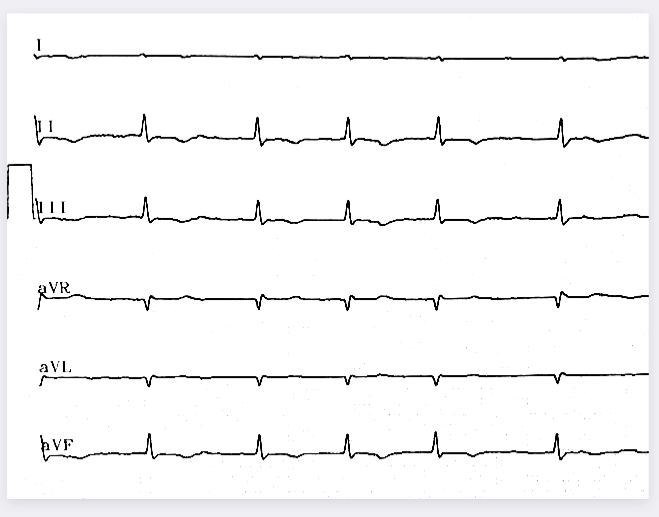 Paciente de 72 años con cirugía reciente de pericardiectomía por pericarditis constrictiva que desarrolló sepsis pulmonar, cuyo ECG no permite visualizar la presencia de ondas P, utilizándose la columna de solución salina como electrodo intracavitario lo que permite determinasr la presencia de FA