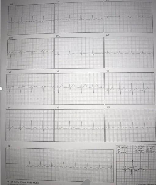 Paciente de 35 años con antecedentes familiares de enfermedad coronaria que presenta ángor y PEG + por dolor a quién se realiza angio TAC  que demuestra suboclusión de la DA