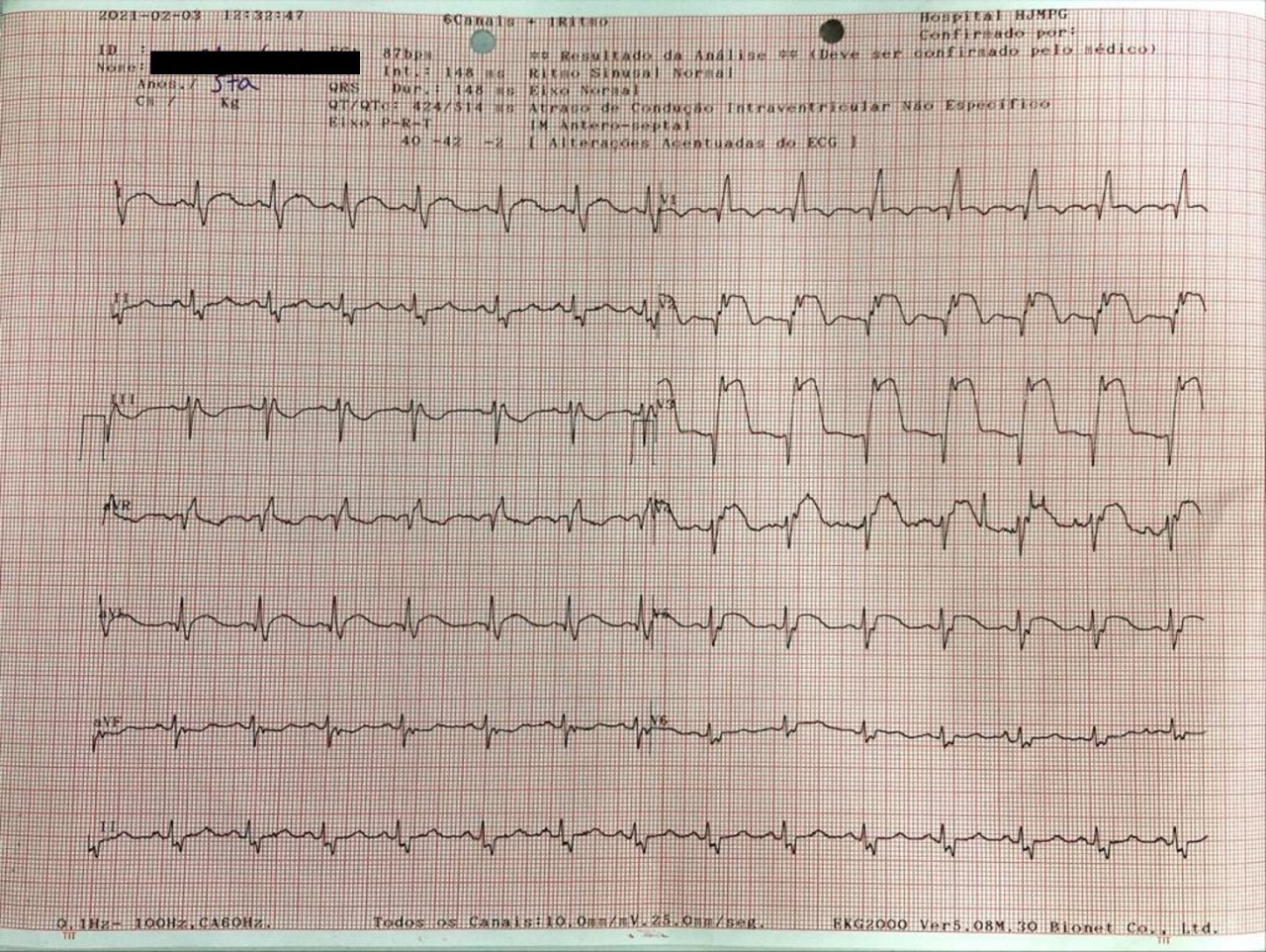 Hombre de 57 años con episodio de ángor prolongado por lesión de DA proximal que muestra en el ECG gran supradesnivel ST en cara anterior con BCRD que no desaparece luego de practicada la angioplastia por tratarse de un bloqueo previo