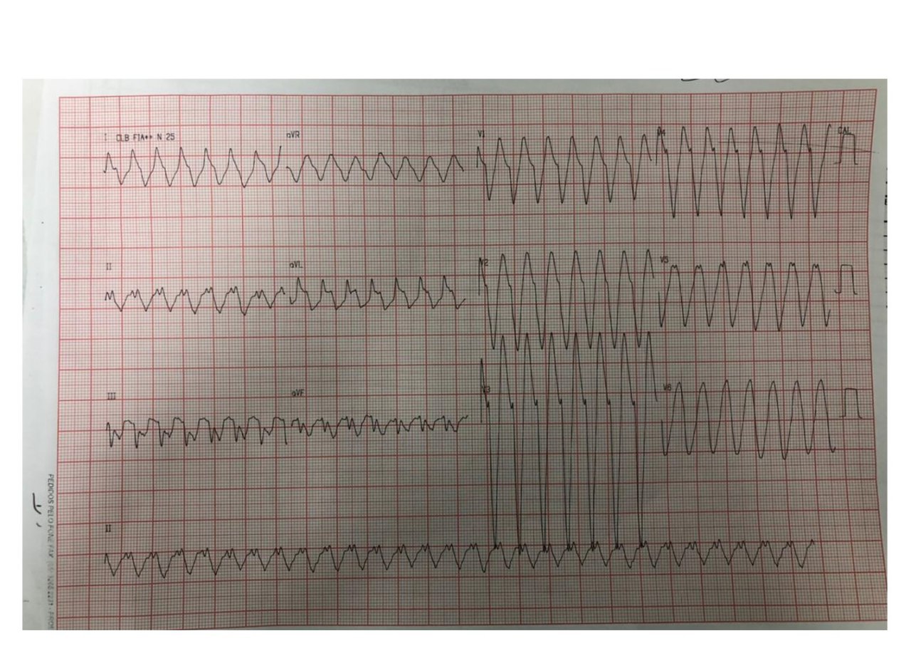 Varón de 51 años con antecedentes de valvuloplastias mitral y aórtica y ACV embólico, a quién se practica CVE, saliendo con ritmo unional, cuyo ECG en ritmo sinusal presenta ECG que muestra crecimiento de la aurícula izquierda y bloqueo auricular avanzado atípico, todo lo cual orienta al diagnóstico del  primer ECG hacia un AA 1:1