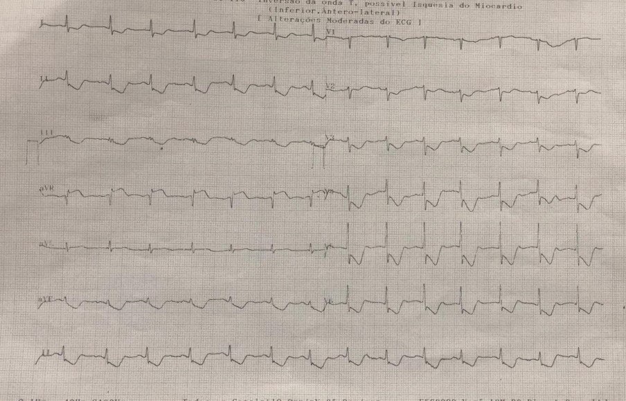 Trazado  de paciente con ángor que presenta isquemia circunsferencial por oclusión del 90% de TCI