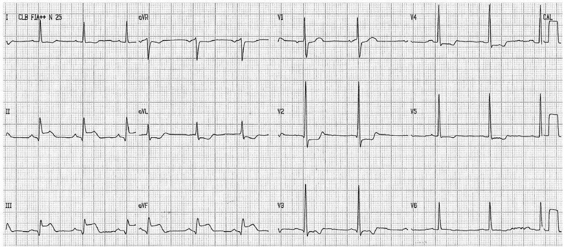 Hombre de 59 años, que presenta ángor prolongado cuyo ECG presenta un STEMI acompañado de fuerzas anteriores prominentes (PAF), con CCG que reveló una obstrucción proximal completa de la arteria coronaria derecha. (CD) con una lesión crítica concomitante en el ostium de la descendente anterior, a quién se implantan sendos stents con ulterior desaparición de las FAP