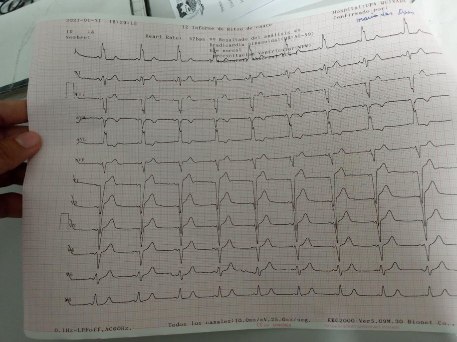 Mujer de 76 años con ángor prolongado e intenso, acompañado de disnea que presenta RIVA con conducción retrógrada, con latidos de fusión, que presenta una suboclusión de la DA con presencia de trombo y probable reperfusión espontánea