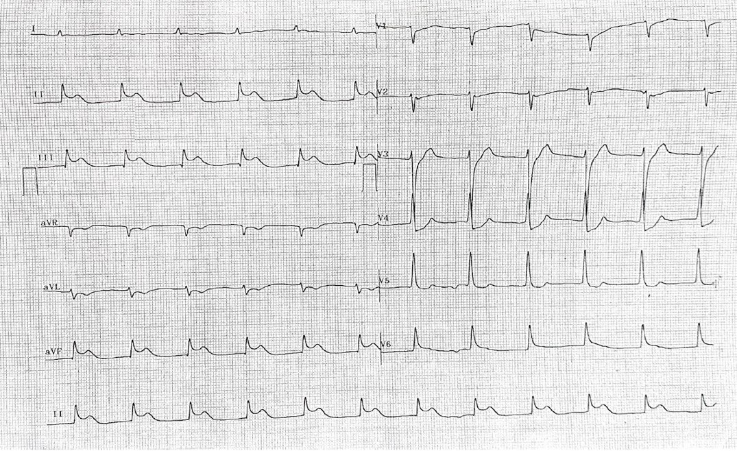 Varón de 29 años con antecedente de COVID 19 leve hace 2 meses que es recuperado de MS que presenta WPW y probable repolarización precoz a quién se realiza EEF presentado durante la estimulación auricular aumento de la conducción por la vía accesoria, desarrollando TRAVO que logra controlarse con amiodarona