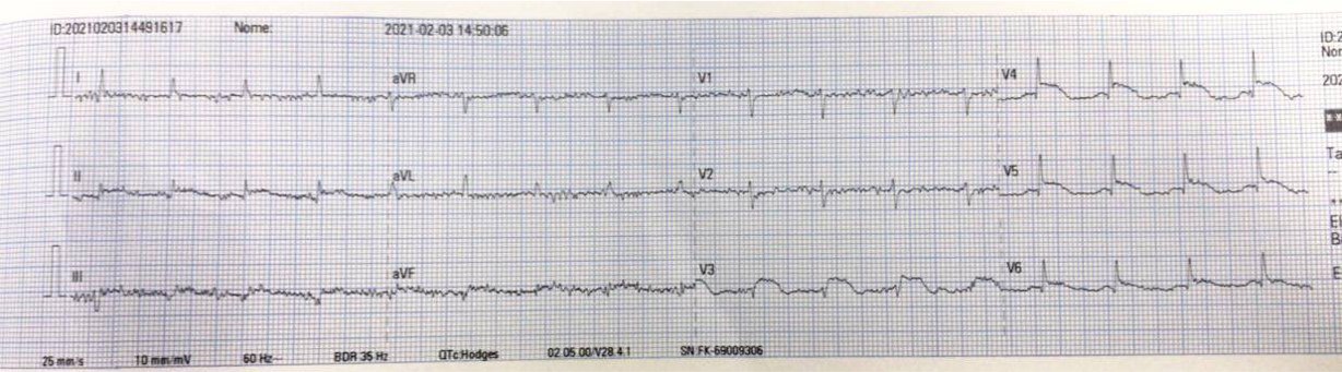 Mujer de 71 años con Alzheimer avanzado y desnutrición. En PO de rectosigmoidectomía por volvo, complicado con necrosis en colostomía + posible infección local y necesidad de nuevo abordaje quirúrgico que presenta inestabilidad hemodinámica, constatándose presencia de síndrome de Takotusubo + IC aguda