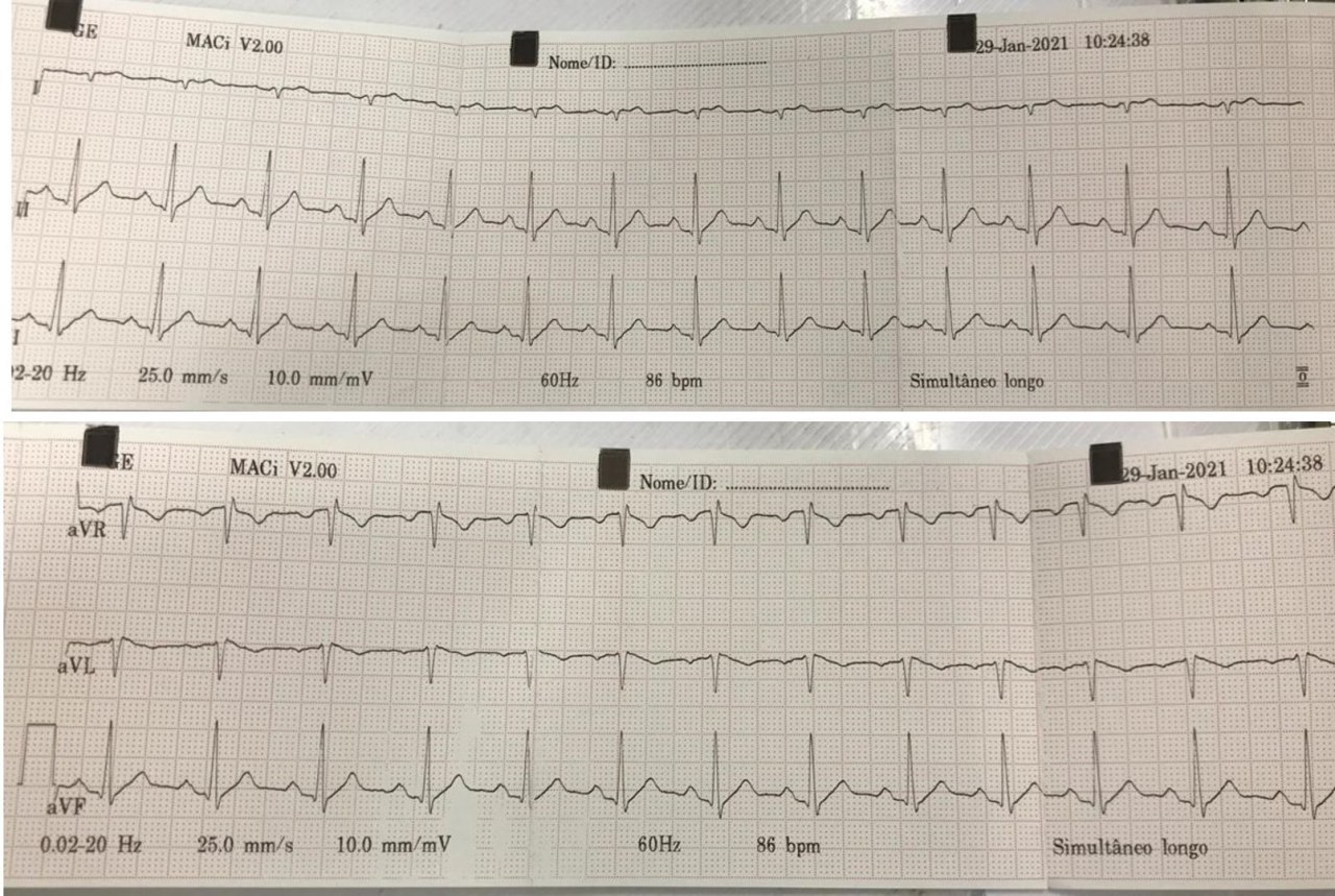 Paciente de 34 años con dolor toráccico atípico, con antecedente de hermano con MS, que presenra patrón de Brugada tipo I en el ECG a quién se realizará EEF para decidir o no el implante de DAI