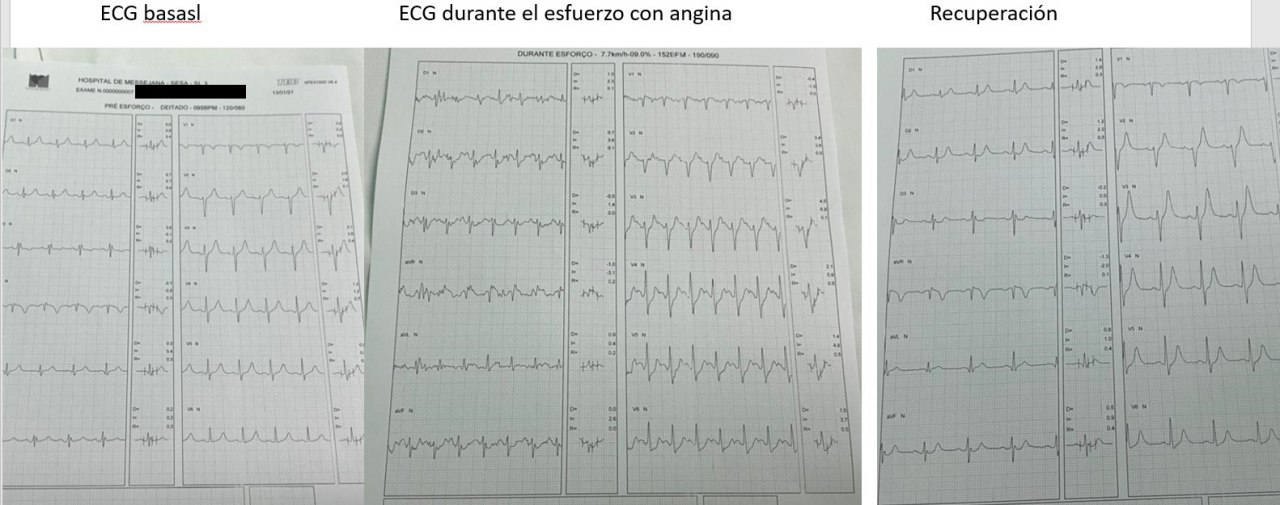 Hombre de 57 años a quién se realiza PEG cuyos hallazgos corresponden a una lesión crítica proximal de la CD