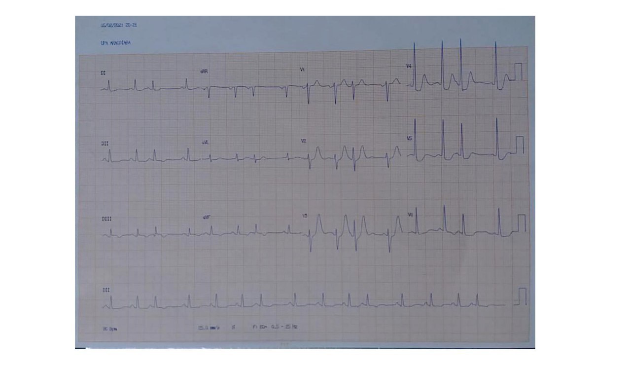 Paciente de 73 años, fumador con episodio de ángor prolongado con imagen ECG correspondiente a síndrome de Winter, en este caso por lesión de la Cx