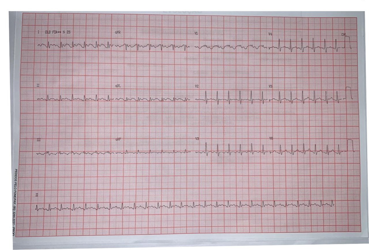 Mujer de 30 años cursando embarazo de 3 meses con antecedentes de arritmias por lo que estaba medicada con atenolol que suspendió, que presenta palpitaciones y lipotimia, en relación a AA 1:1 siendo medicada con adenosina