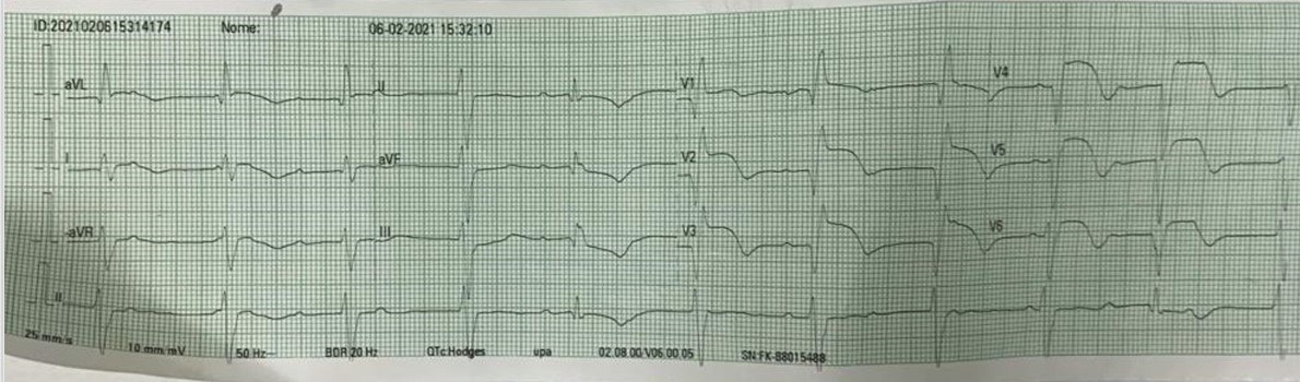 Mujer de 50 años, HTA, DBT y dislipemia con ardor retroesternal irradiado a dorso desde hace tres días, que presenta BAVC con escapes anchos y QTc prolongado que presenta enfermedad multivasos con DA 100% ocluída, recibiendo angioplastia de los tres vasos con mal resultado final