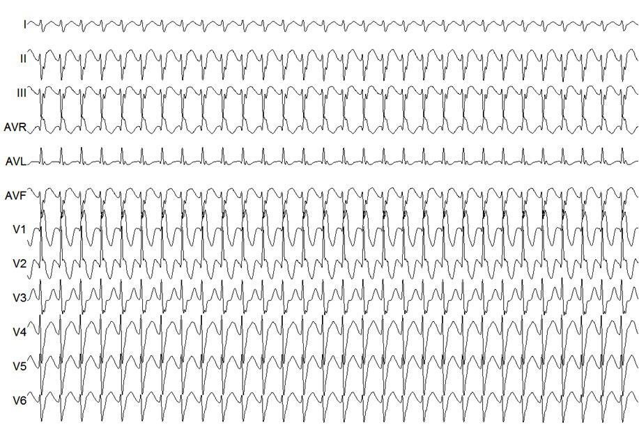 Varón 28 años con palpitaciones frecuentes a pesar del uso de B-bloqueantes y amiodarona que recibe adenosina IV presentando disociación AV sin interrumpir la taquicardia, descartándose TRAVO y TRIN, con diagnóstico final de TV fascicular posterior