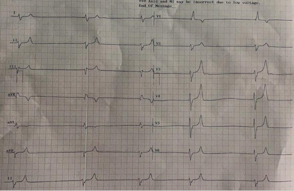 Paciente de 57 años, HTA, DBT y dislipémico, con antecedente de cirugía de bypass AoCo hace 10 años, con 3 cateterismos previos, que presenta dolor epigástrico, sudoración y somnolencia que presenta kalemia de 6,7 y creatinina muy elevada que recibe gluconato de Ca, e indicación de hemodiálisis
