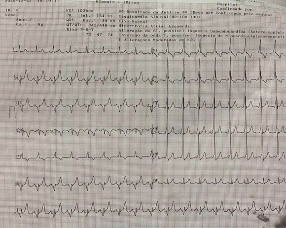 Varón de 36 años que consulta por dolor epigástrico y sudoración con sospecha de SCA que en realidad presenta síndrome de WPW con CCG normal