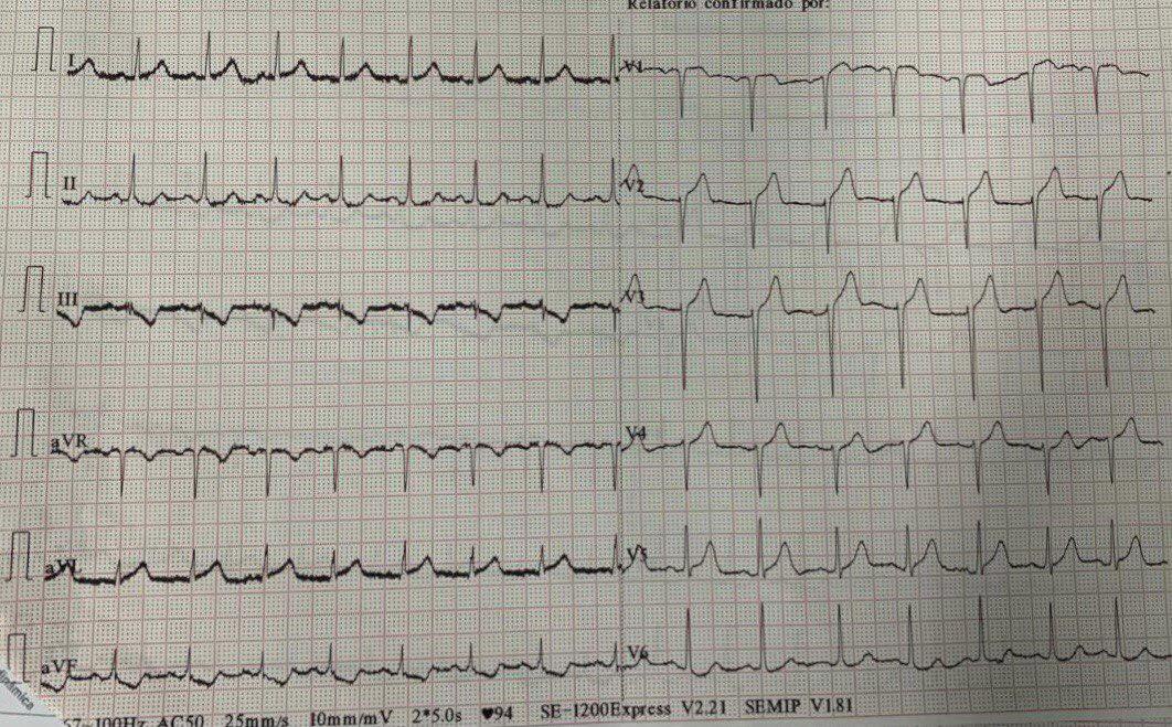 Paciente con episodio de dolor anginoso en cuyo ECG se observan signos de isquemia grado 1 en cara anterior con cambios recíprocos en cara inferior con una CCG donde se observa oclusión de la DA con presencia de trombo